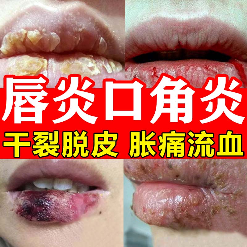 唇炎专用药膏唇炎唇膏嘴唇干裂脱皮去角质去死皮硝酸咪康唑乳膏