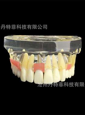 M2005牙齿模型种植牙模型牙齿种植演示模型医患沟通模型