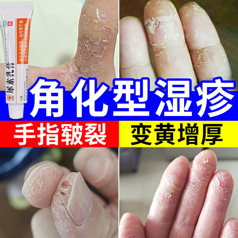 尿素乳膏皮肤干裂脱皮瘙痒手掌粗糙发黄变厚皮炎慢性湿疹止痒膏