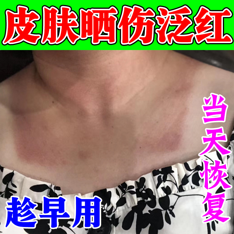 紫外线晒伤修复药膏脖子皮肤晒黑印子红痒日光性皮炎屏障受损专用