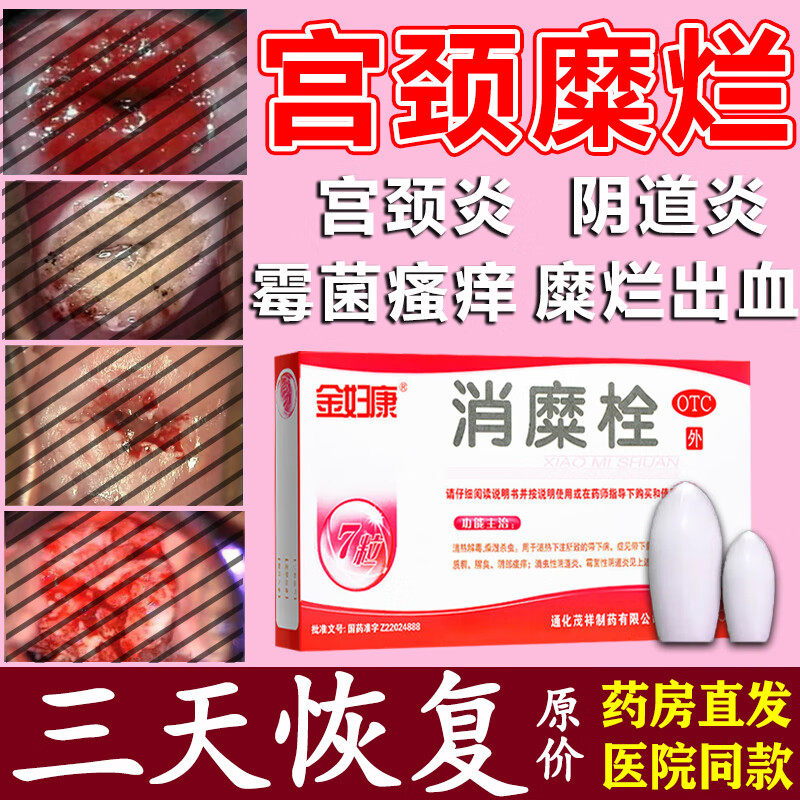 妇炎洁凝胶阴道炎妇科用药宫颈糜烂重度专用中药消糜栓烂糜阴道塞