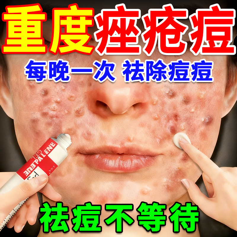 【花容美】阿达帕林凝胶0.1%*10g*1支/盒