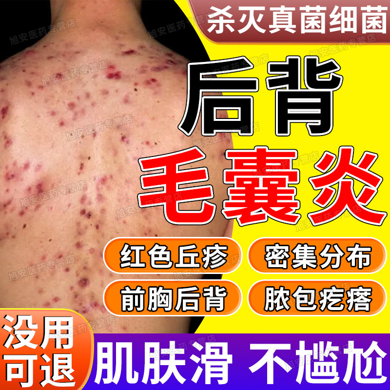 治疗毛囊炎专用药前胸后背长痘痘红肿硬块克林霉素甲硝唑搽剂