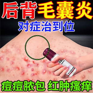 治疗毛囊炎专用药膏前胸后背长痘痘毛囊炎硬疙瘩痘痘祛痘痤疮药膏
