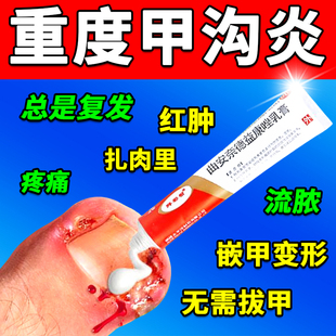 甲沟炎治疗专用特根效药膏治第一指甲名软化剂息肉去除神长肉里器
