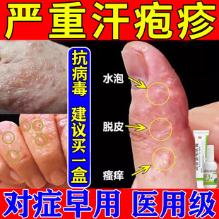 阿昔洛韦抗病毒软膏乳膏正品手上起小水泡汗状疱疹药膏特喷雾效药