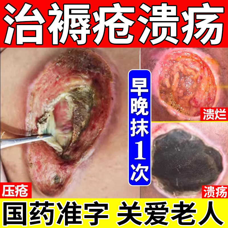 褥疮特治效专货用药膏氧化锌软膏正品成人长期卧床老人臀部外用疗,OTC药品/国际医药,抗菌消炎,淘宝优惠券,粉丝福利购,淘宝优惠卷