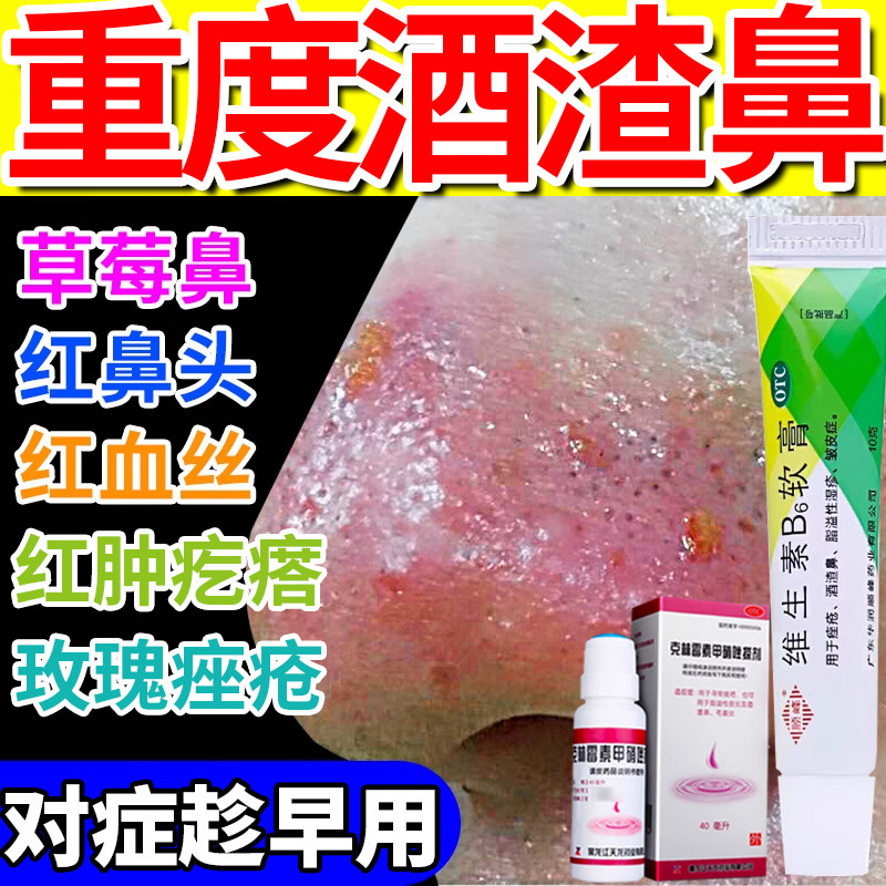 治酒糟鼻红鼻子专用药酒渣鼻特新效药膏去红鼻头鼻子红肿玫瑰痤疮