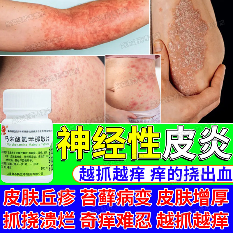 神经性皮炎口服药特应性效药日光性皮炎紫外线过敏晒伤瘙痒止湿疹