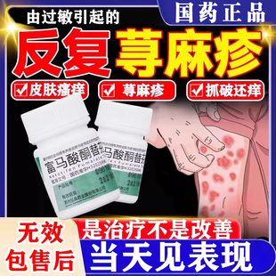 富马酸酮替芬片寻荨麻疹过敏止痒断痒根专用治疗荨麻疹的特痒效药