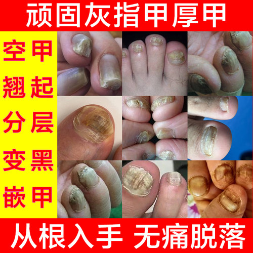 灰指甲无痛脱甲膏甲沟炎抑菌液快速脱甲精油脚趾甲嵌甲灰甲软化剂