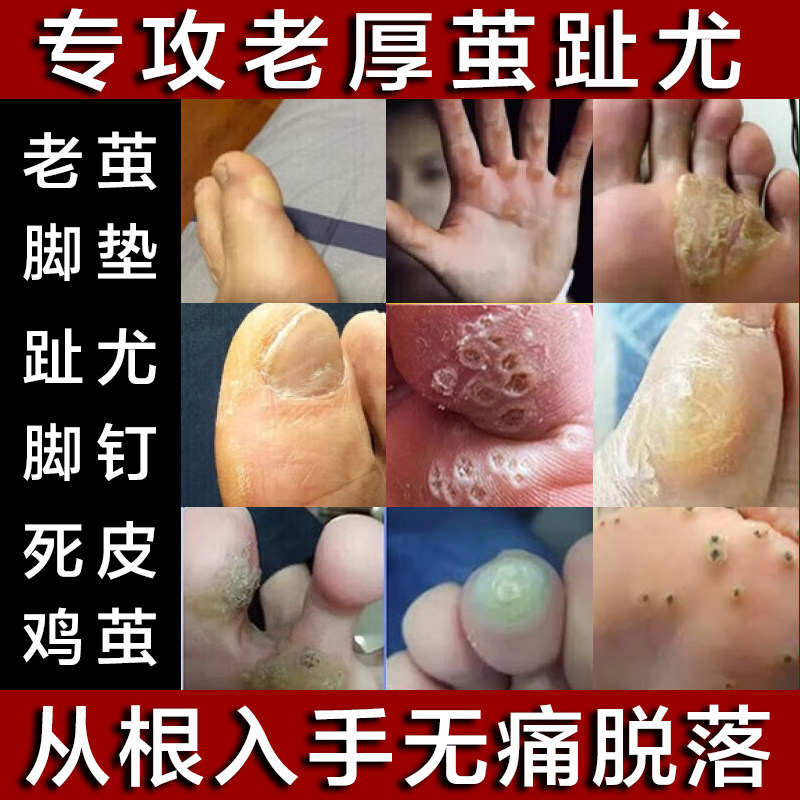 去除手脚上老茧脚垫死皮脚底厚脚趾指脚底硬茧老茧厚皮脚茧软化剂