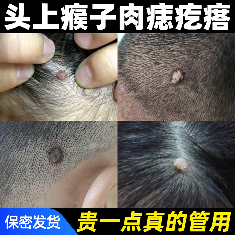 专注去除头上瘊子肉疙瘩刺猴