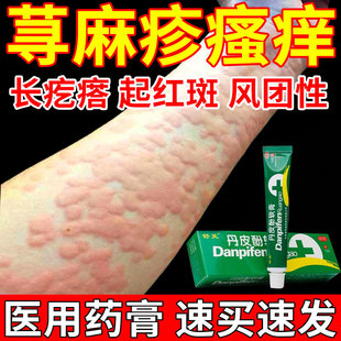荨麻疹过敏止痒药膏 皮肤瘙痒寒冷性荨麻疹疙瘩风团药皮肤用药S