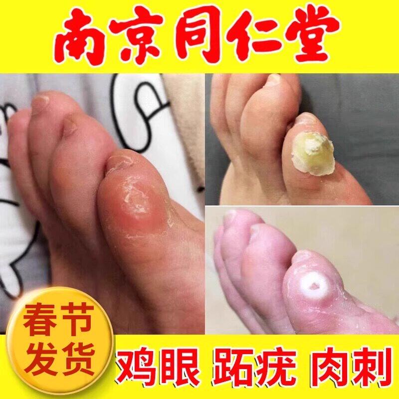 南京同仁堂鸡眼贴膏药鸡贴眼跖疣肉刺瘊子脚底疙瘩老茧尤平净正品 - 实物图
