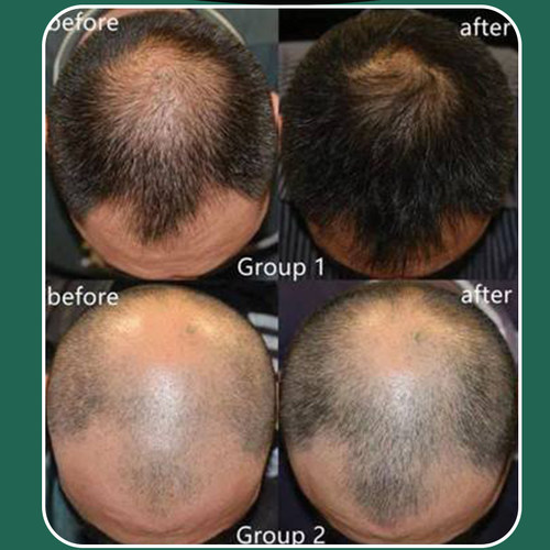 极速YOUNGCOME 30/60g Ginger Hair Loss Treatment HTair Growth