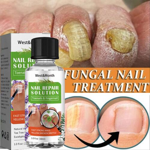 极速Tea Tree Naikl Fungal Treatment Feet Essence Anti Infect