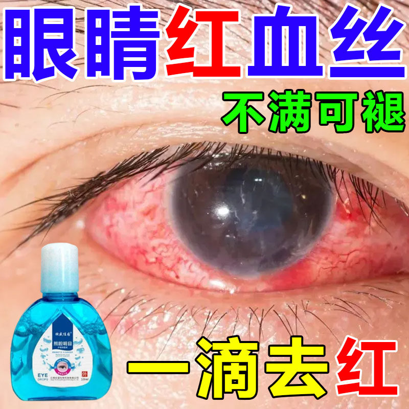 极速眼睛红血丝修复去除去黄去红血丝滴眼液缓解眼睛疲.劳粘稠眼