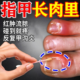 甲沟炎治疗专用药指甲往肉里长特消肿去肉芽息肉消炎化脓效药膏
