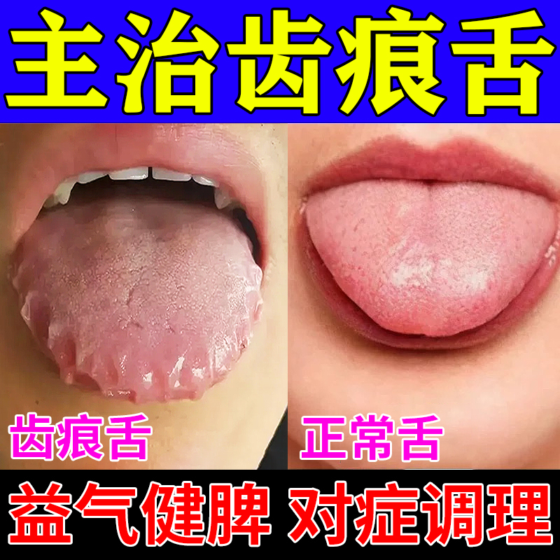 齿痕舌调理中成药去脾虚湿气舌头舌苔白厚裂纹有齿痕香砂六君丸