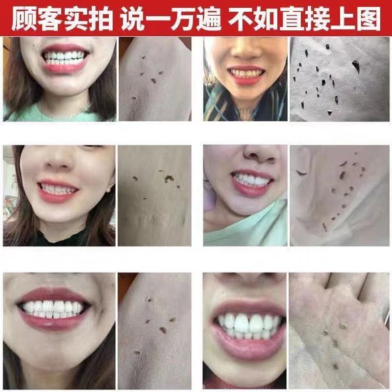 现货牙齿打磨机电动清洁磨牙器牙结石烟渍虎牙磨平器抛光修牙磨牙