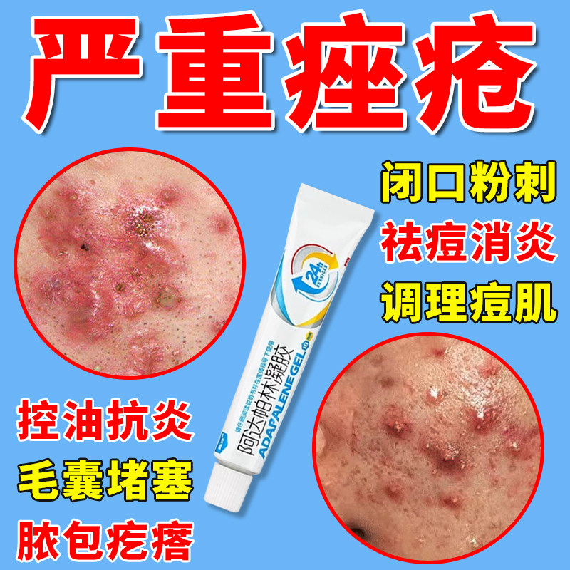 严重痤疮粉刺脓包