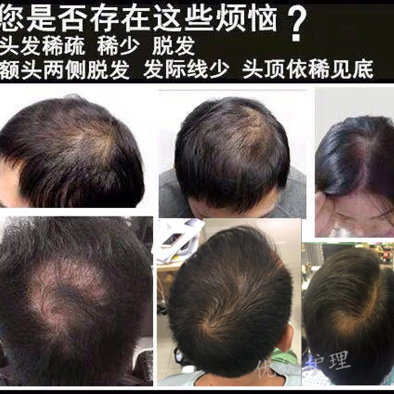 密发增发纤维f粉头发变浓密遮秃头顶填充粉补发神器假发美发粉喷