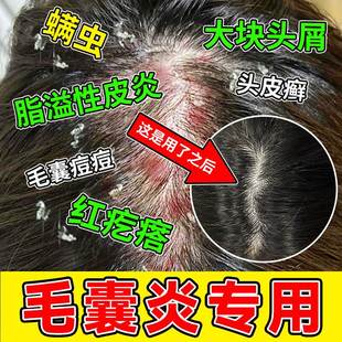 头部头皮屑癣头上长痘痘结痂可搭毛囊炎洗发水专用搭药膏中药克星