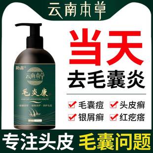头部头皮屑癣头上长痘痘结痂可搭毛囊炎洗发水专用搭药膏中药克星