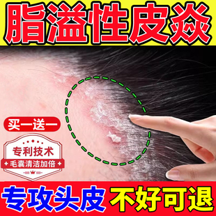 毛囊真菌感染专用正品 脂溢性去头皮屑喷剂止痒炎煤焦油洗发水套装