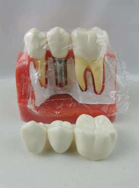 M2017R种植牙齿模型 牙冠可分离