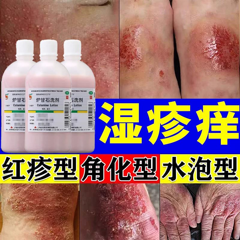 【信龙】炉甘石洗剂5%5%15%*100ml/瓶