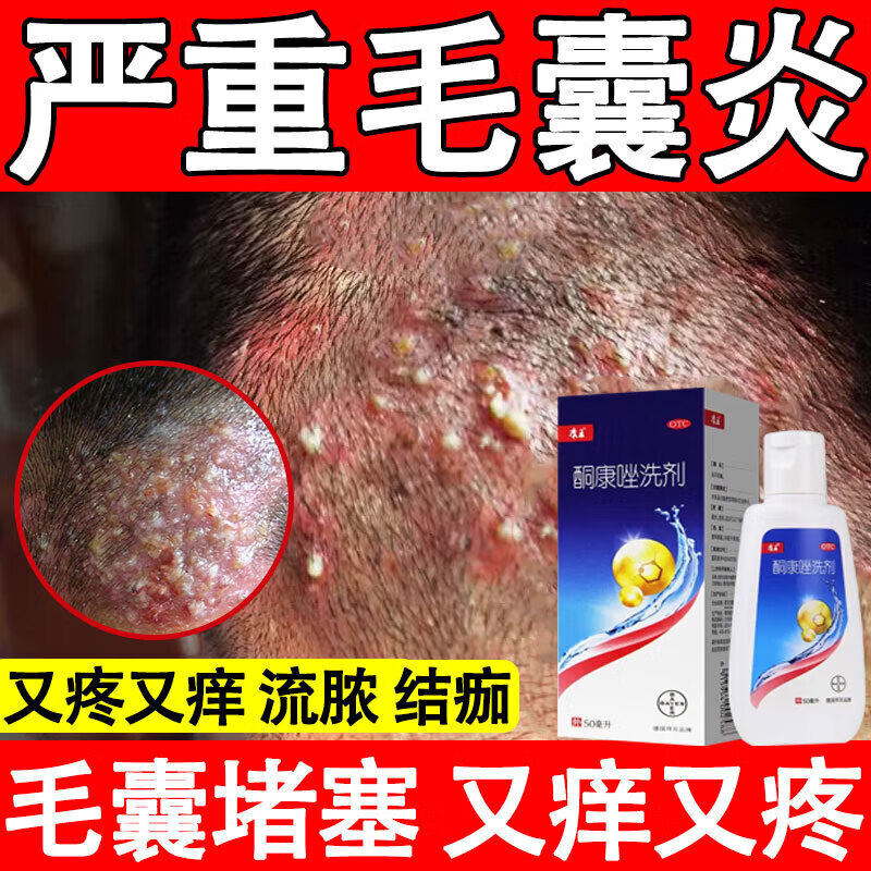 康王复方法酮康唑发用洗剂脂溢性皮炎洗发水去屑止痒控毛囊炎油
