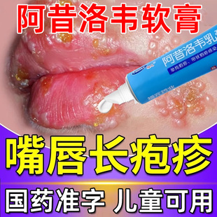 嘴唇疱疹阿昔洛韦软膏乳膏正品特嘴角疱疹嘴巴疱疹嘴唇凝胶效药膏