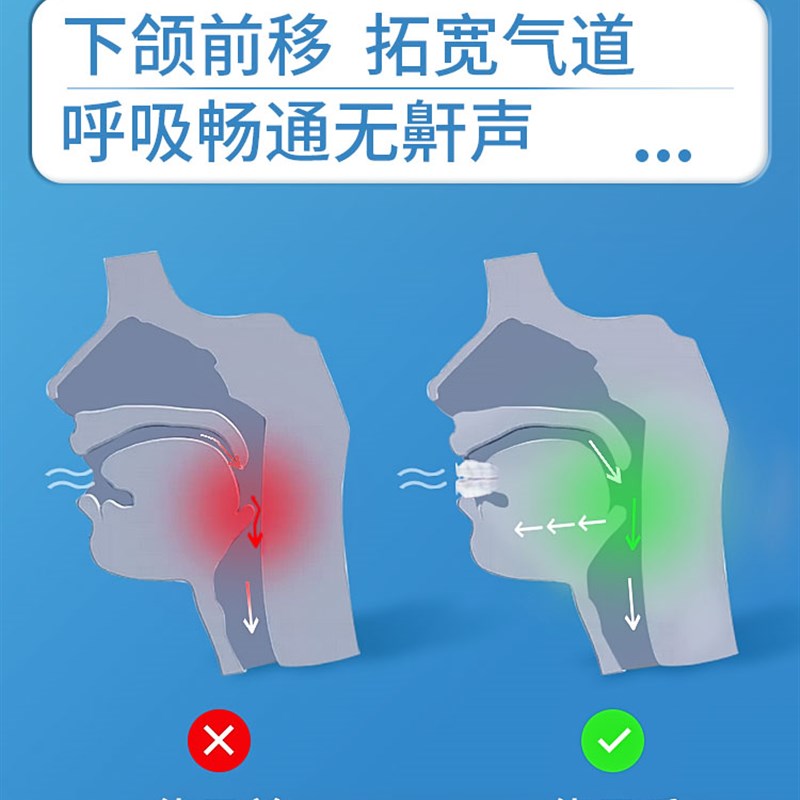 止鼾牙套神器阻止打鼾打呼噜止鼾器呼吸暂停口腔矫治器机防呼噜消