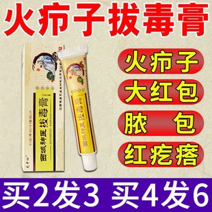 火疖子拔毒拨垠拔脓红肿拔毒疙瘩大脓包痘痘坐扳疮屁股大包去脓包