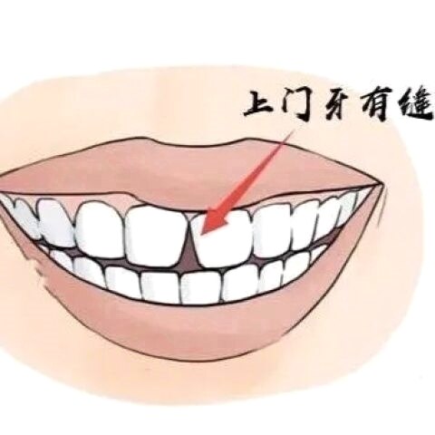 门牙缝隙大遮盖临时修补材料补牙口腔填充修复牙科安全牙缝牙齿自