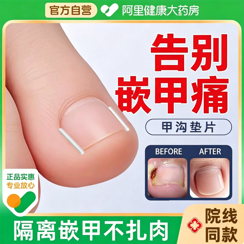甲沟矫正器贴片炎嵌甲神器防脚指甲往肉里长专用隔离工具填充垫片