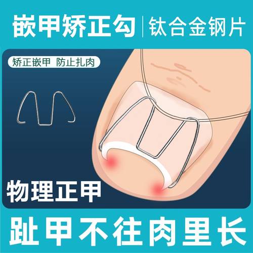 甲沟炎矫正器嵌甲矫正勾