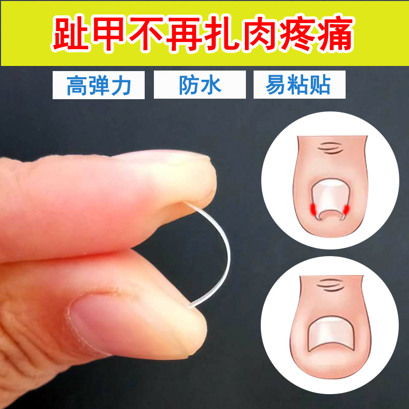 云格森大脚趾甲沟焱炎嵌甲矫正片