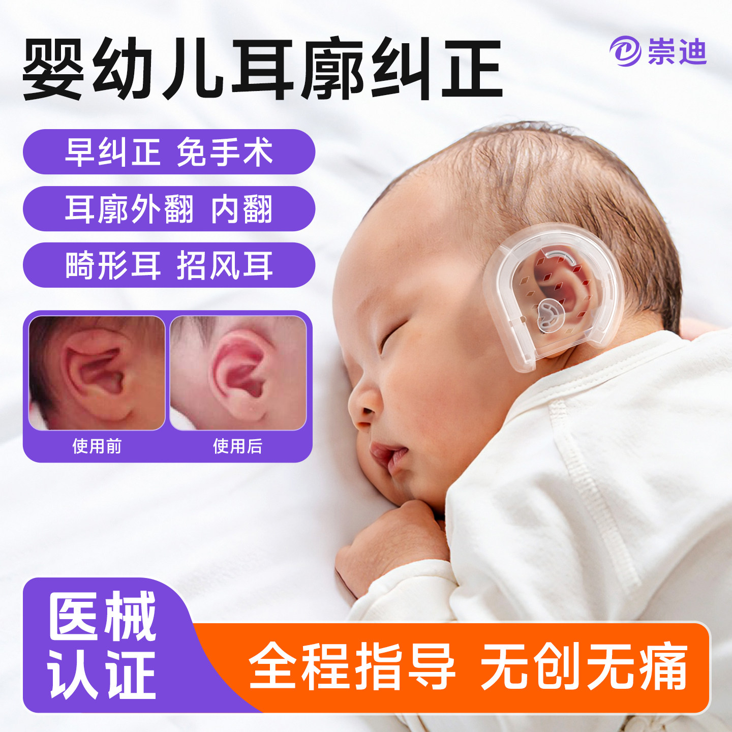崇迪医用级婴儿耳朵矫形器医院同款新生儿耳廓矫正器宝宝耳朵定型