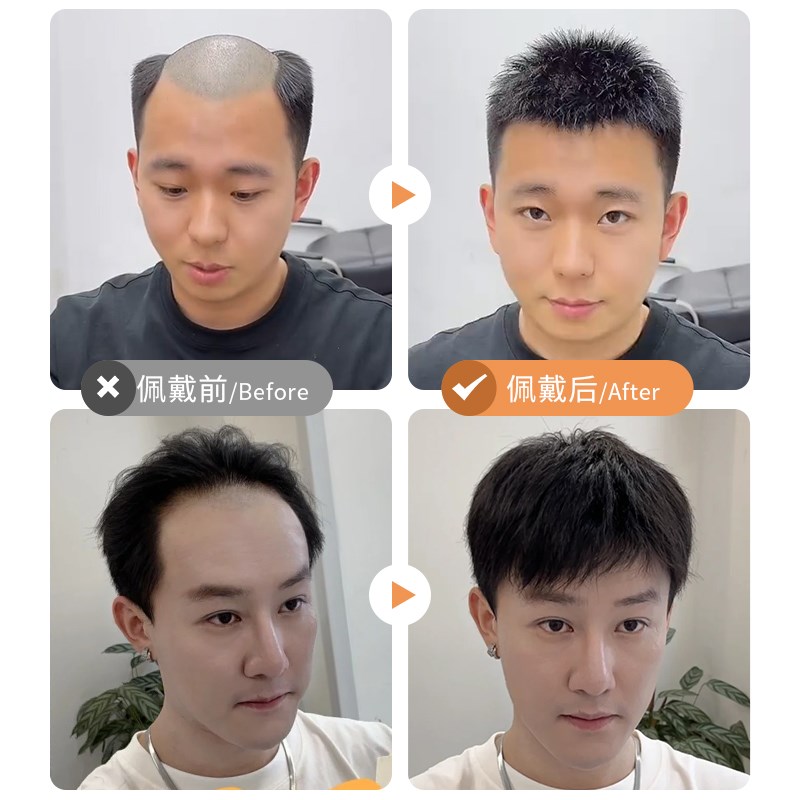 男士假发全递针真发高端头顶补发片自然遮秃前额隐形无痕生物头皮