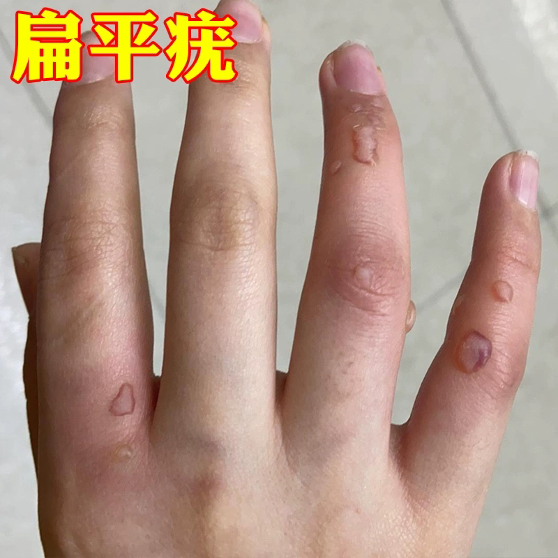 特效去扁平疣丝状跖疣液全身用