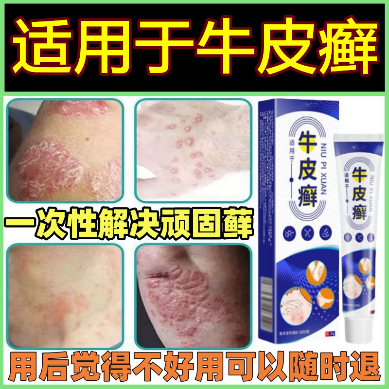 牛皮癣藓药膏银屑病去止痒根手足顽癣真菌感染皮肤瘙痒抑菌外用治