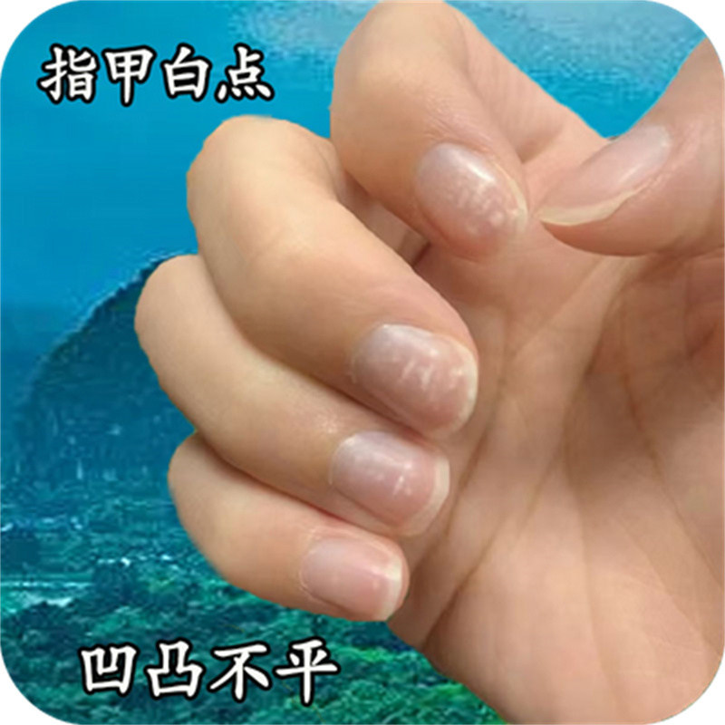 指甲修护膏手指甲盖凹凸不平甲面多条横纹指甲变形有褶皱凹坑药乳
