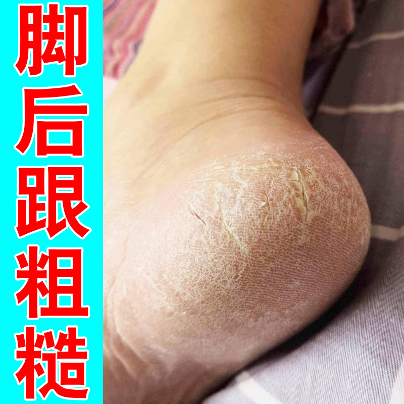 脚后跟粗糙干裂蜕皮专用角化型脚皮肤消毒护理（消）