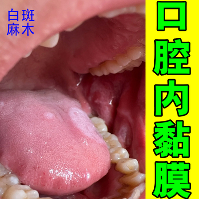 白纹舌头起泡专用糜烂溃烂网状药