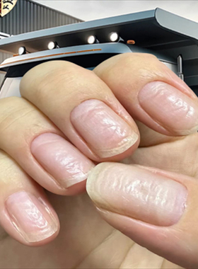 大拇指指甲有黑色竖纹黑线手指甲真菌感染手指甲护理手指甲修复膏