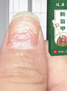 指甲黑色竖纹黑线大拇指甲母痣手指甲真菌感染手指甲护理膏去黑线