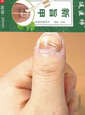 手指甲面有黑色竖纹淤血表面凹凸不平坏甲药专用膏真菌感染空心甲
